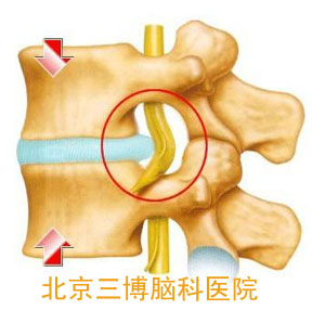 椎間盤突出