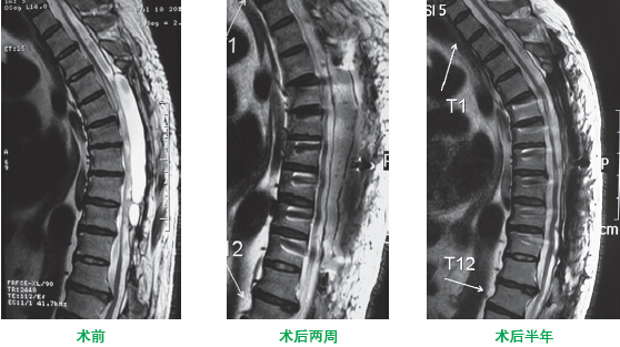 椎管內(nèi)蛛網(wǎng)膜囊腫病