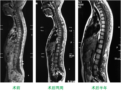 椎管內(nèi)蛛網(wǎng)膜囊腫