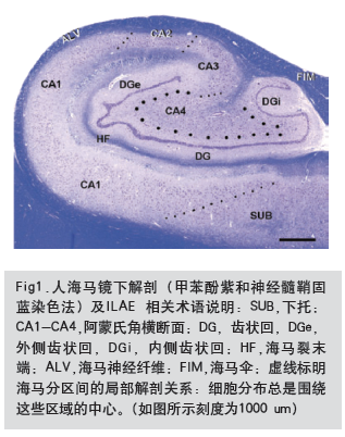 顳葉癲癇