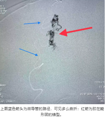 上圖藍(lán)色箭頭為微導(dǎo)管的路徑，可見(jiàn)多么曲折；紅箭為膠在畸形團(tuán)的鑄型。