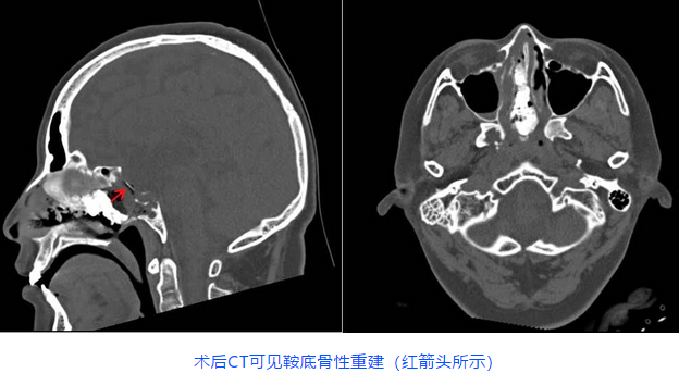 術后CT可見鞍底骨性重建(紅箭頭所示)