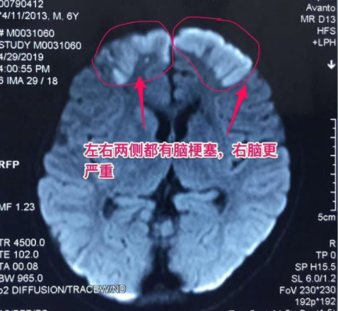 中老年多發(fā)腦梗，6歲兒童竟中招！說話不清、肢體無力、活動障礙、頭暈頭痛…要警惕！