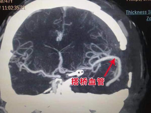 46歲男子腦腫瘤包裹大血管 先搭橋后切腫瘤同期手術(shù)救患者