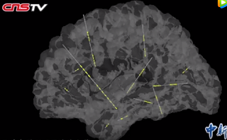 精準(zhǔn)深入大腦深處 創(chuàng)傷小效率高，確定癲癇病灶