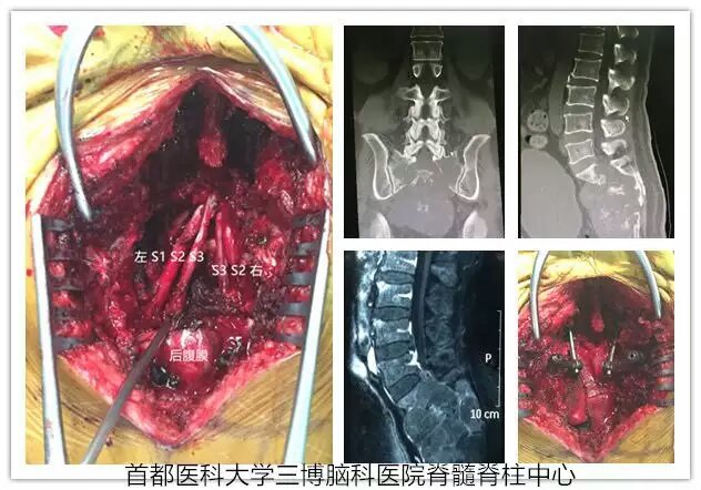 骶骨巨大腫瘤