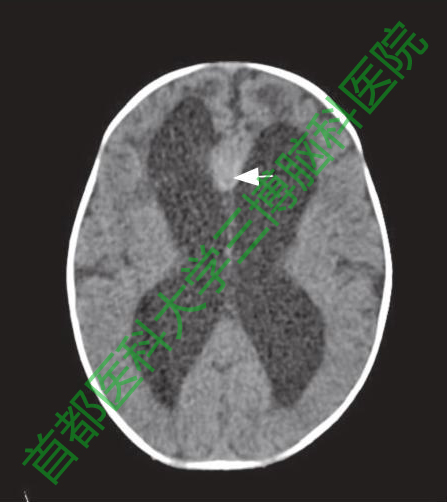 圖1手術前頭CT。箭頭示縱裂池內稍高密度病灶。