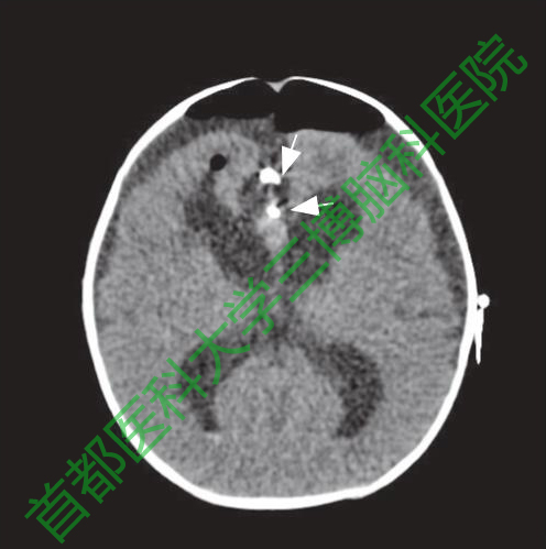 圖5手術后20小時頭CT。腦室較手術前變小。白色箭頭示動脈瘤夾。