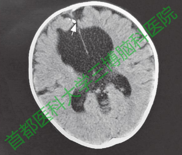 圖6手術后20個月復查頭CT，腦室仍有擴張。白色箭頭示動脈瘤夾。