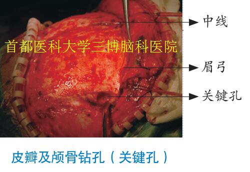 皮瓣及顱骨鉆孔（關鍵孔）