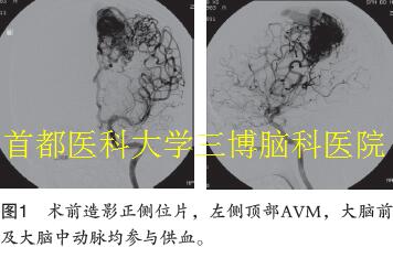 圖1 術(shù)前造影正側(cè)位片，左側(cè)頂部AVM，大腦前 及大腦中動脈均參與供血