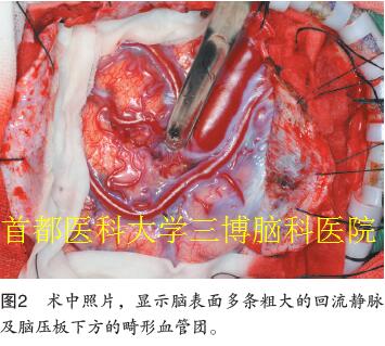 圖2 術(shù)中照片，顯示腦表面多條粗大的回流靜脈 及腦壓板下方的畸形血管團(tuán)