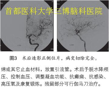 圖3 術(shù)后造影正側(cè)位片，病變切除完全