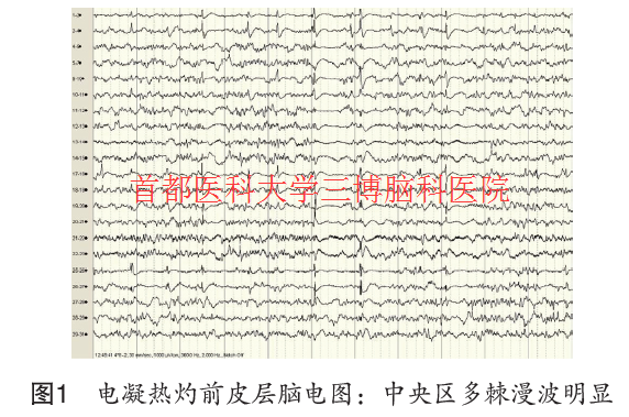 圖1 電凝熱灼前皮層腦電圖：中央?yún)^(qū)多棘漫波明顯