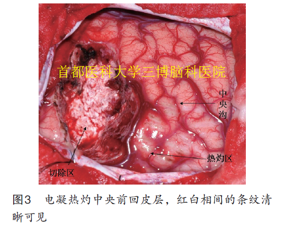 圖3 電凝熱灼中央前回皮層，紅白相間的條紋清 晰可見(jiàn)