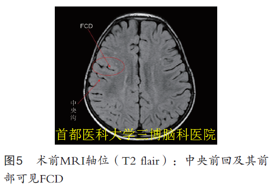 圖5 術(shù)前MRI軸位（T2 flair）：中央前回及其前 部可見(jiàn)FCD