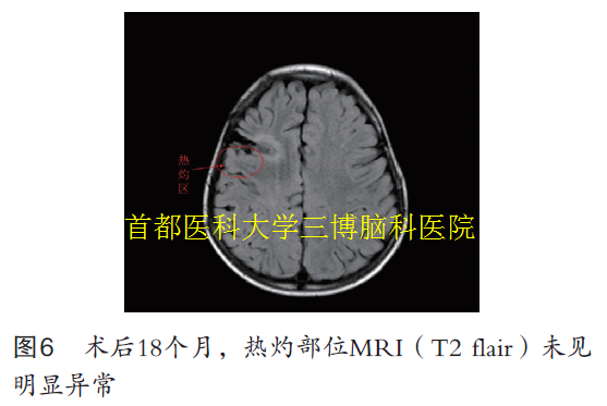 圖6 術(shù)后18個(gè)月，熱灼部位MRI（T2 flair）未見(jiàn) 明顯異常