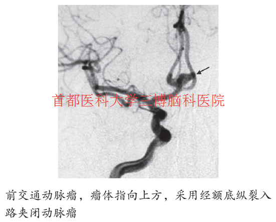 前交通動脈瘤，瘤體指向上方，采用經(jīng)額底縱裂入 路夾閉動脈瘤