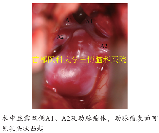 術(shù)中顯露雙側(cè)A1、A2及動脈瘤體，動脈瘤表面可 見乳頭狀凸起