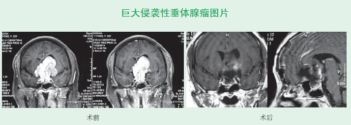 巨大侵襲性垂體腺瘤