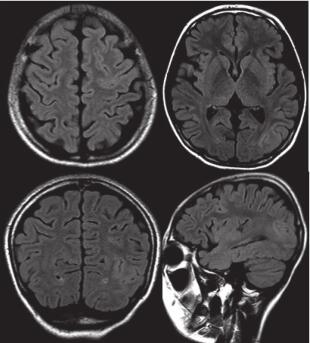 圖 2. 患者頭顱 MRI：左頂枕及左額葉皮層異常信號。