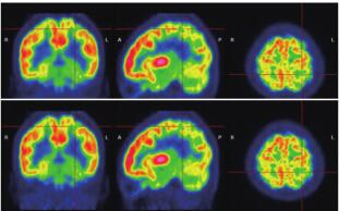圖 3. 患者 PET：左側(cè)枕葉、顳、頂葉放射性攝取較對 側(cè)明顯減低。