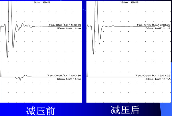 術(shù)中電生理監(jiān)測術(shù)