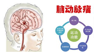 為什么會得腦動脈瘤？腦動脈瘤常見病因