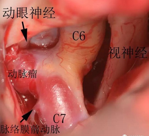 動脈瘤