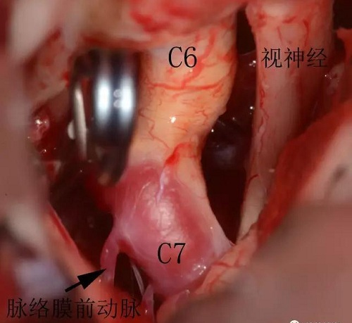 一枚動脈瘤夾夾閉動脈瘤瘤頸之后，動脈瘤消失