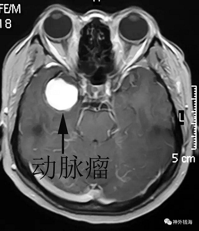 巨大血栓性動(dòng)脈瘤