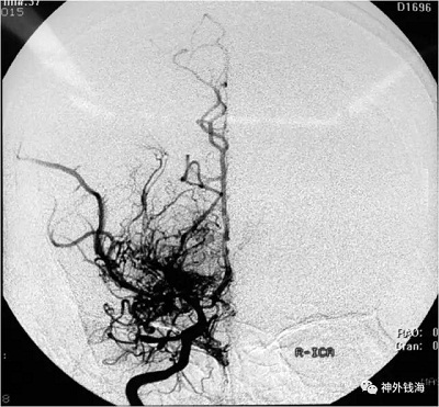 煙霧病(Moyamoya disease)