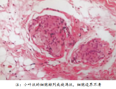 顱內(nèi)外溝通性腦膜瘤怎么治療好？