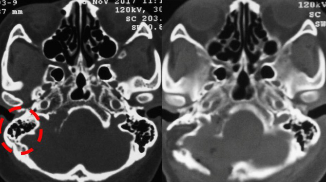 左圖為術(shù)前CT可見頸靜脈孔擴(kuò)大不明顯，舌下神經(jīng)管擴(kuò)大，右圖為術(shù)后CT可見巖骨磨除范圍。