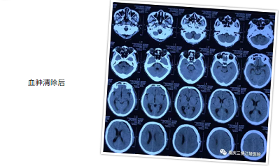 頭部外傷引起頭痛長達(dá)4月之久，三博江陵醫(yī)院2天去除病根