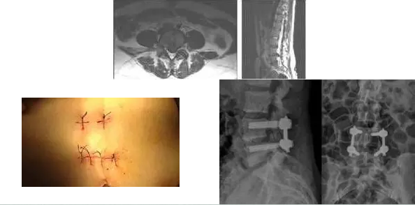 病例二腰椎間盤突出+腰椎管狹窄