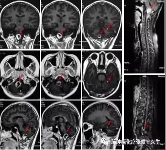 兒童延髓毛細胞型星形膠質(zhì)細胞瘤復(fù)發(fā)播散，該如何治療？