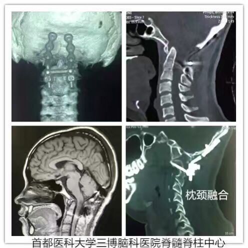 枕大孔區(qū)腦干延髓腹側(cè)腦膜瘤