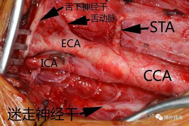 煙霧病術(shù)中照片，顯示相關(guān)結(jié)構(gòu)