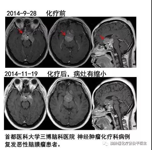 非良性腦膜瘤的化學(xué)治療