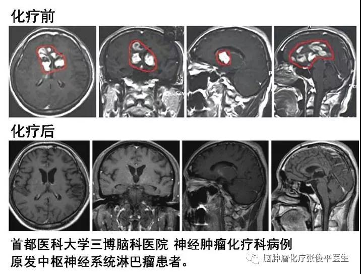 化療