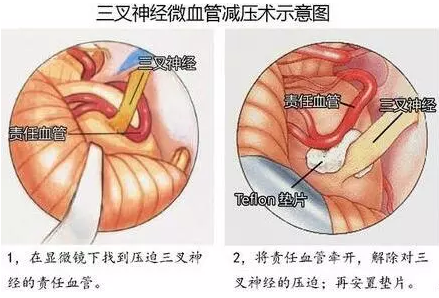 三叉神經(jīng)痛、面肌痙攣……MVD手術(shù)全搞定