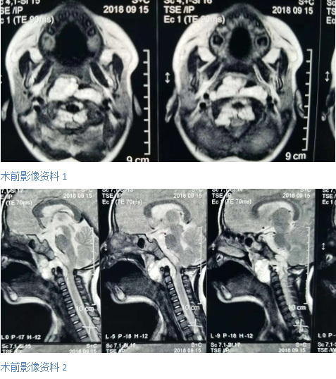 小孩子睡覺打鼾警惕藏有巨大危險