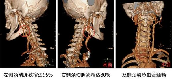 頸動脈被堵只?！耙痪€天” 外科微創(chuàng)疏通生命通道