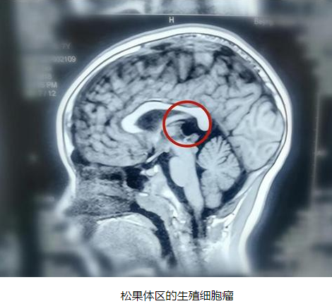 孩子出現(xiàn)性早熟現(xiàn)象 家長(zhǎng)警惕腦瘤作怪