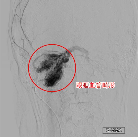 十年眼突又腫脹 原是血管畸形潛伏眼眶