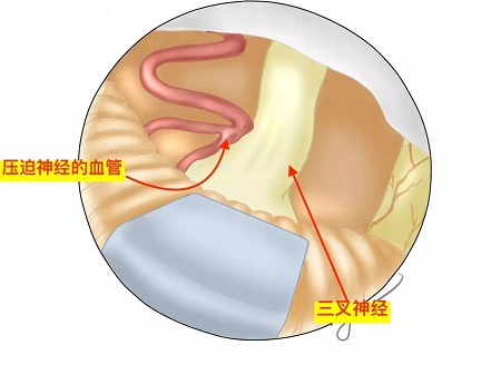 三叉神經(jīng)壓迫血管示意圖