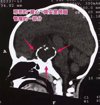 3歲男童身高比同齡矮一頭 沒想到是腦腫瘤搗亂