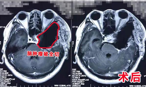 46歲男子腦腫瘤包裹大血管 先搭橋后切腫瘤同期手術(shù)救患者