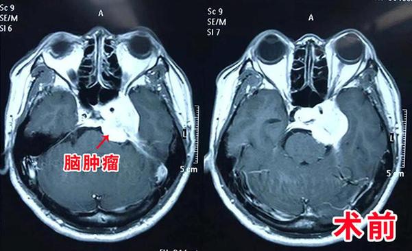 46歲男子腦腫瘤包裹大血管 先搭橋后切腫瘤同期手術(shù)救患者